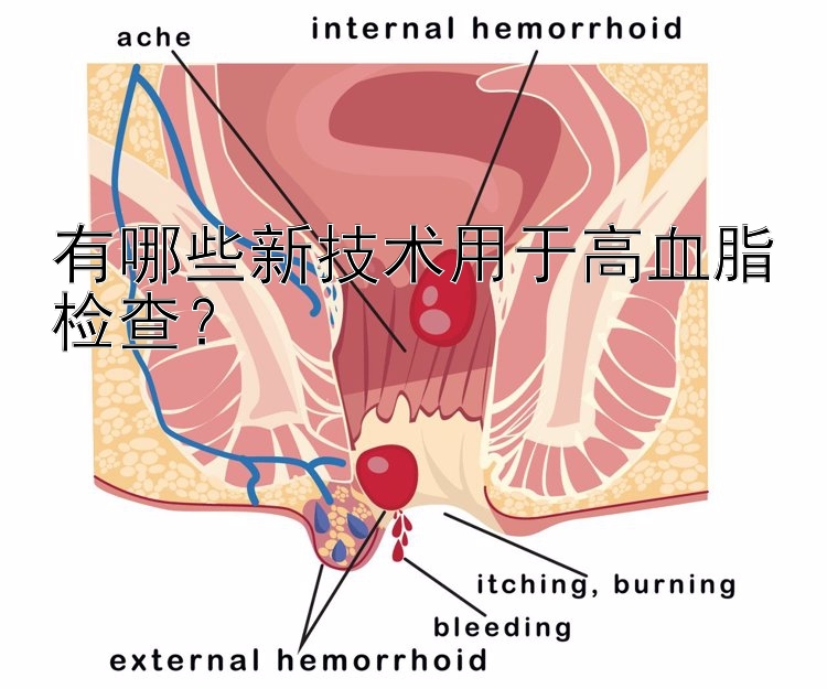 有哪些新技术用于高血脂检查？