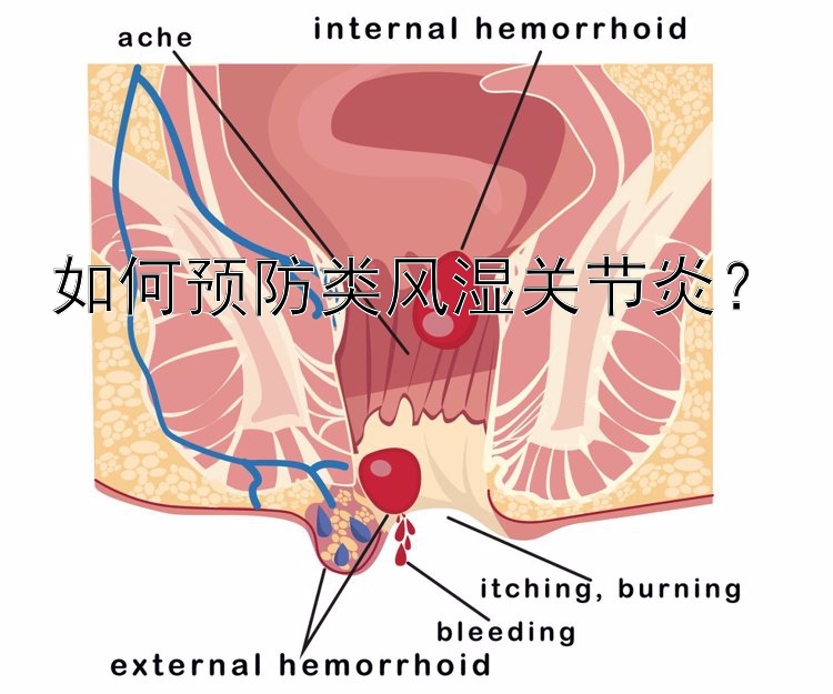 如何预防类风湿关节炎？